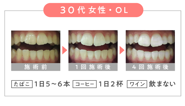 ＼ ３０代 女性・OL ／【 たばこ 】１日5~6本【 コーヒー 】１日２杯 【 ワイン 】飲まない