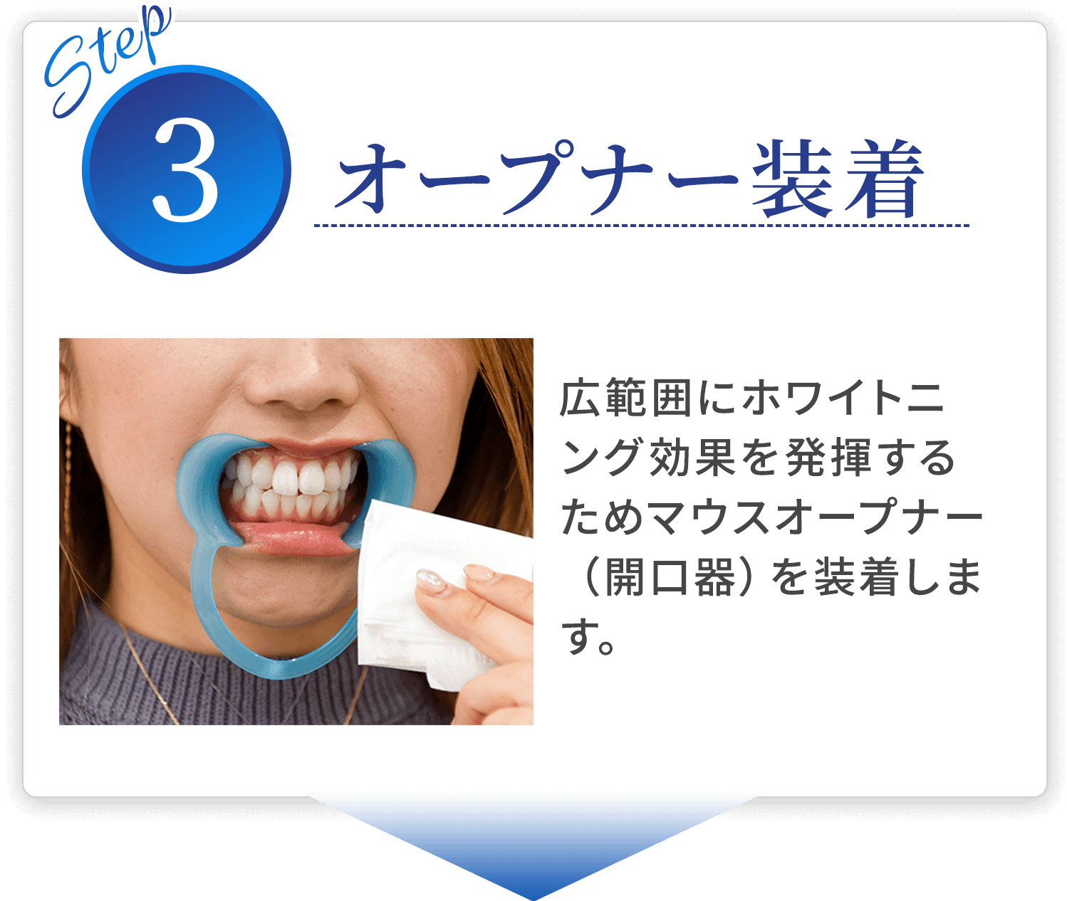 step03 オープナー装着 広範囲にホワイトニング効果を発揮するためマウスオープナー（開口器）を装着します。
